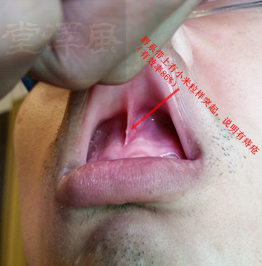 唇系带凸起诊断痔疮的道理并不复杂,只要熟悉经络的运行,就能明白其中
